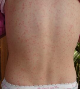 Erupcions cutànies típiques de l'escarlatina